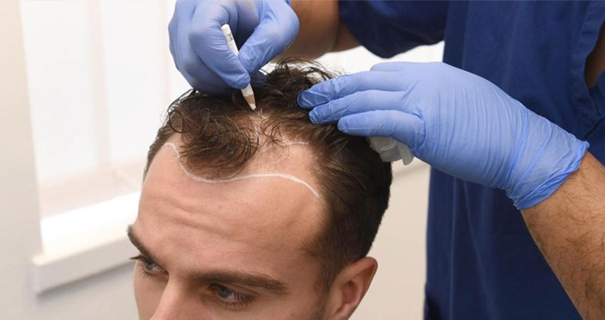 Hair Transplantation And Hair Health