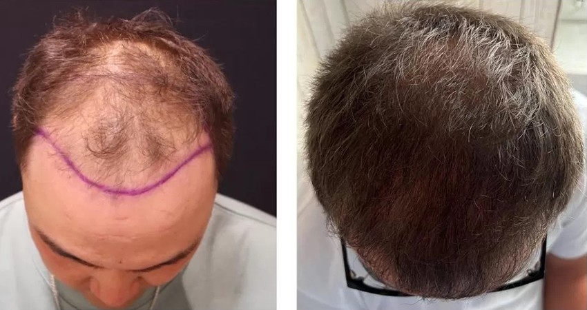 زراعة الشعر وصحة الشعر