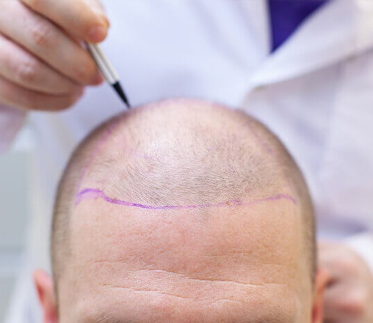 Hair Transplantation And Hair Health